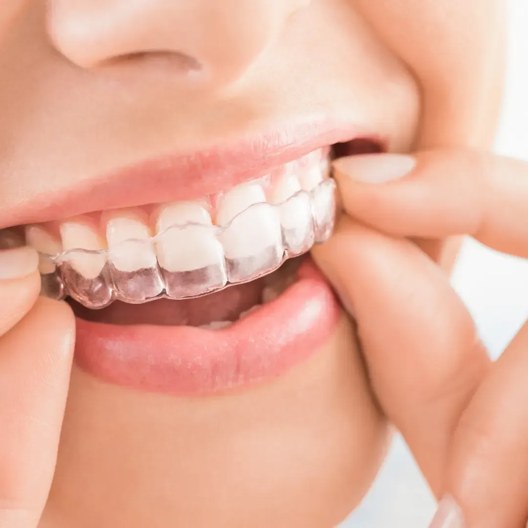Patient putting in a clear aligner
