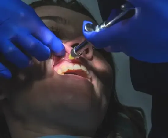 Dentist curing a tooth-colored filling with a curing light