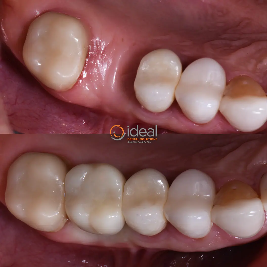 Before and after smile treatment at Ideal Dental Solutions, case 3