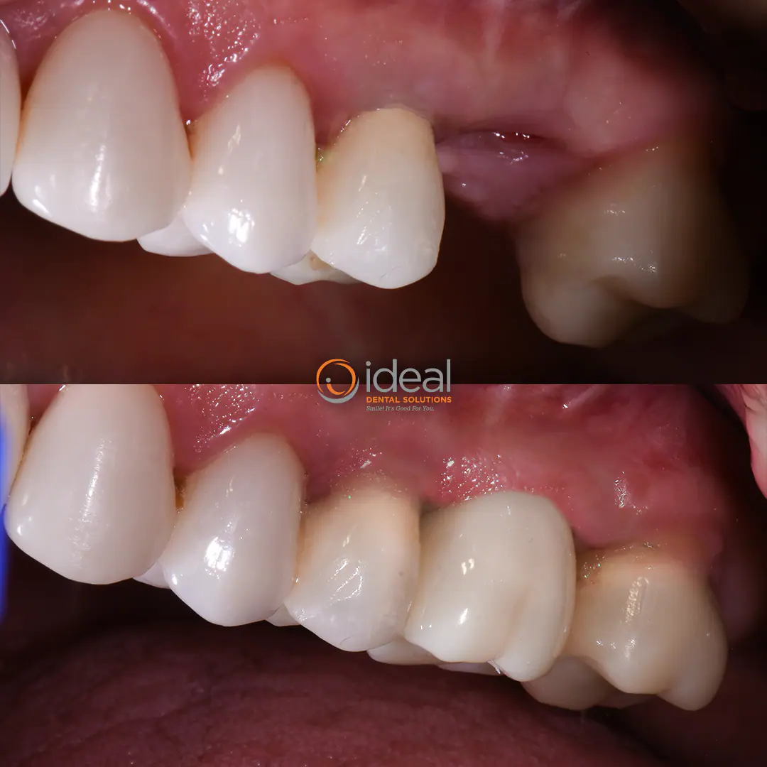 Before and after smile treatment at Ideal Dental Solutions, case 4