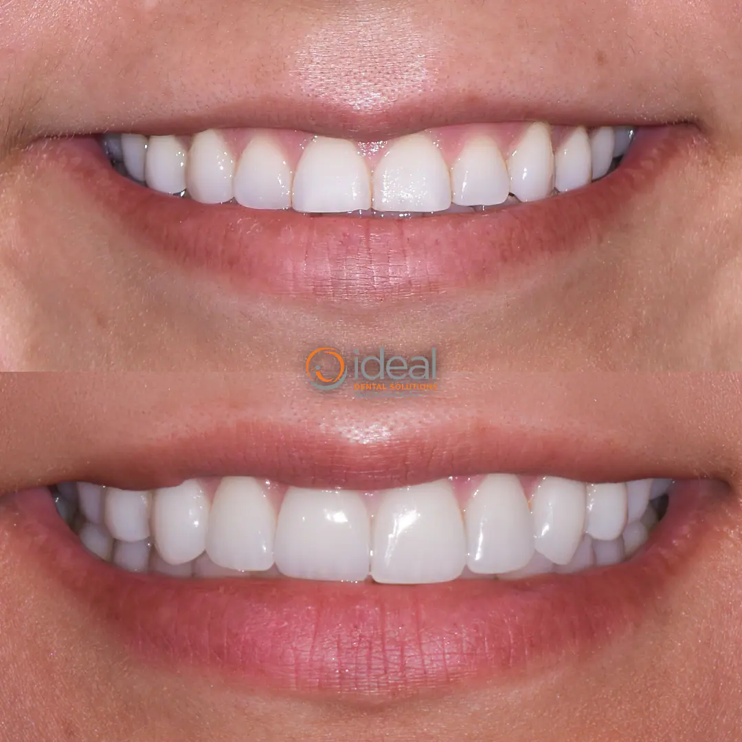 Before and after smile treatment at Ideal Dental Solutions, case 7