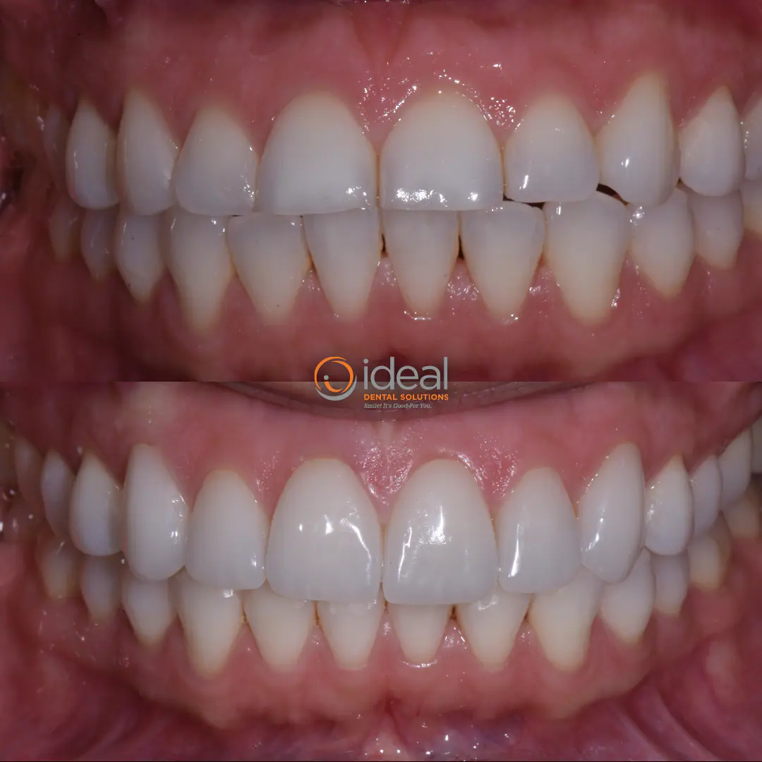 Before and after smile treatment at Ideal Dental Solutions, case 8