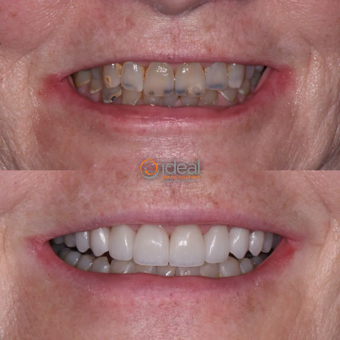 Before and after smile treatment at Ideal Dental Solutions, case 10