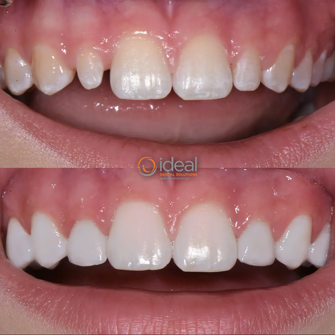Before and after smile treatment at Ideal Dental Solutions, case 15