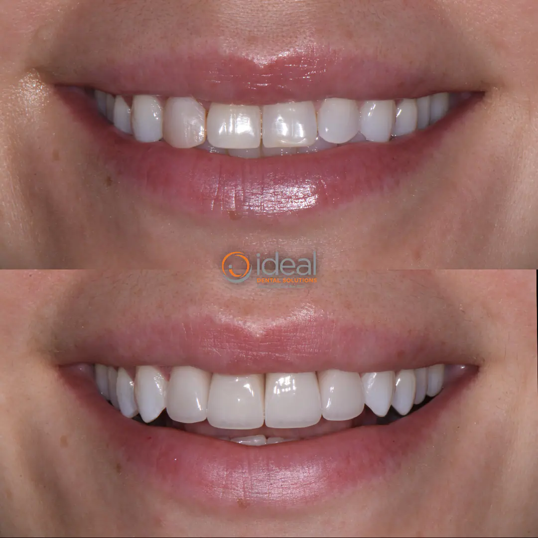 Before and after smile treatment at Ideal Dental Solutions, case 18