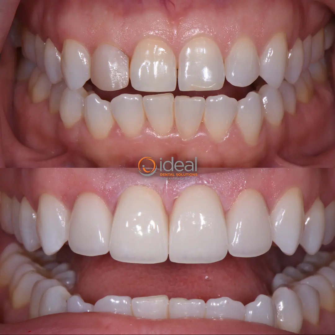 Before and after smile treatment at Ideal Dental Solutions, case 19