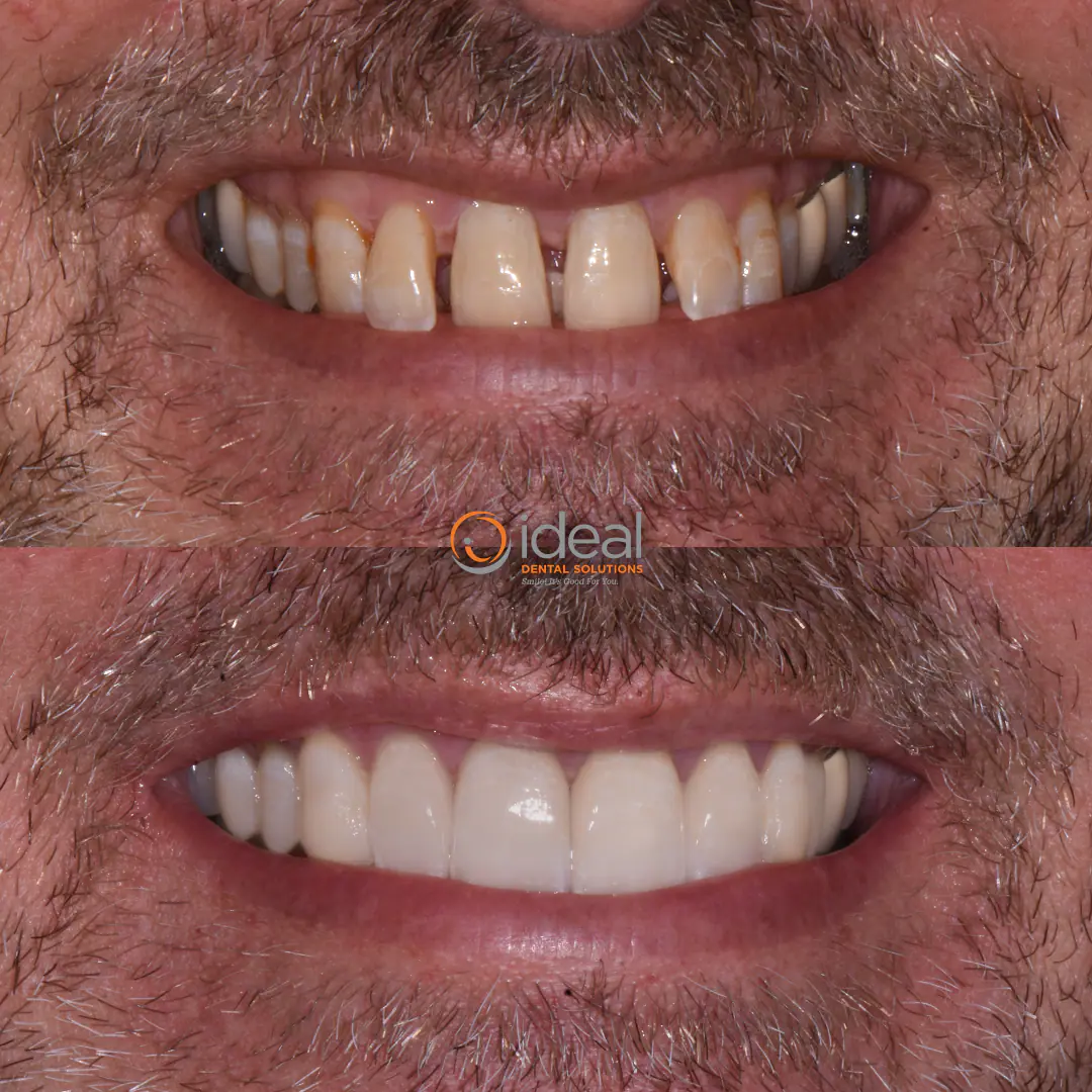Before and after smile treatment at Ideal Dental Solutions, case 20